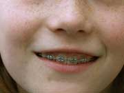 Wann ist eine Zahnspange bei Kindern sinnvoll?