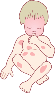 Neurodermitis bei Kleinkindern